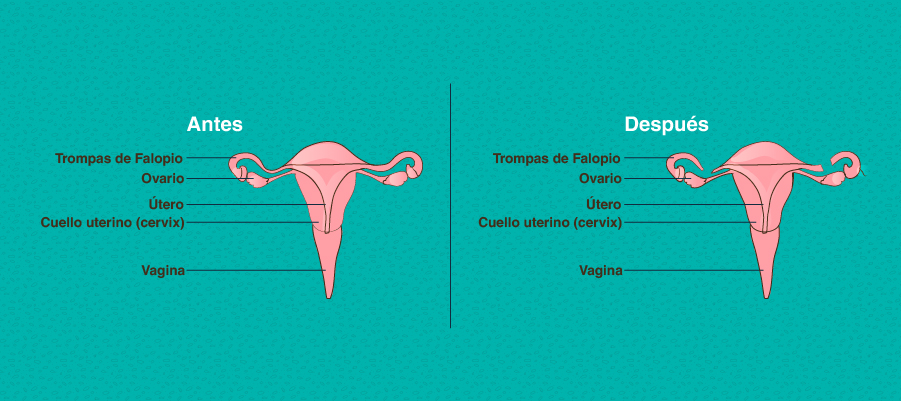 anticonceptivos-ligadura-trompas.jpg